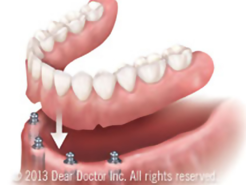 DentalImplants DentalImplants