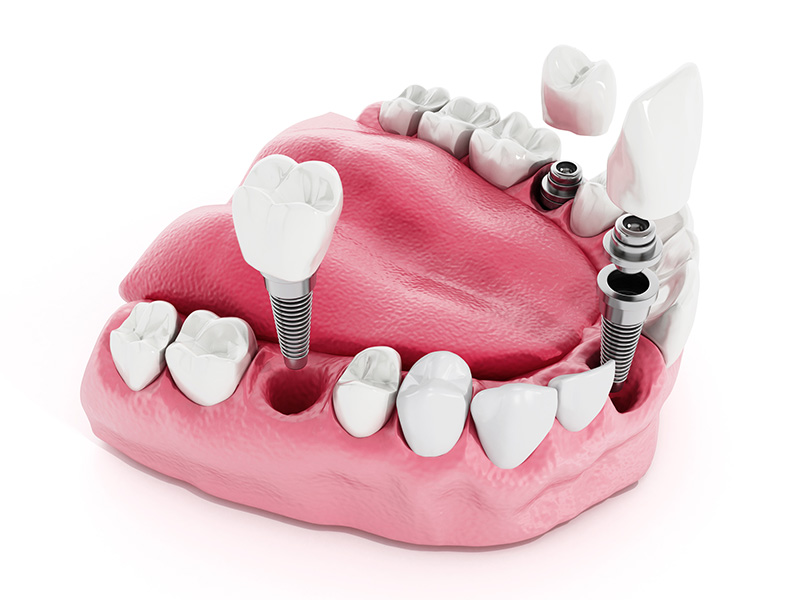 Dental implant detail Dental Implants 3D Rendering Temecula Ca