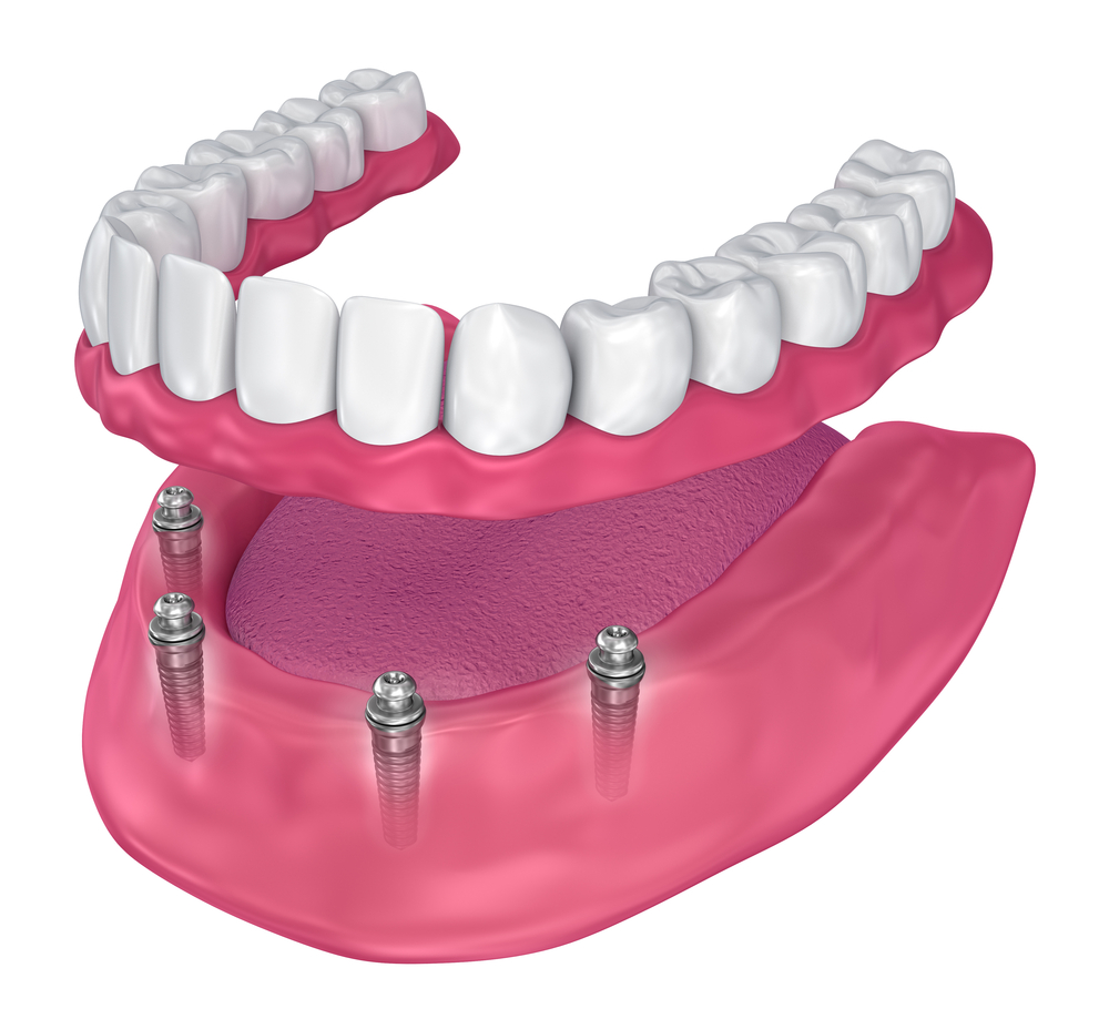 All-On-4 3D Dental Implant Rendering Temecula