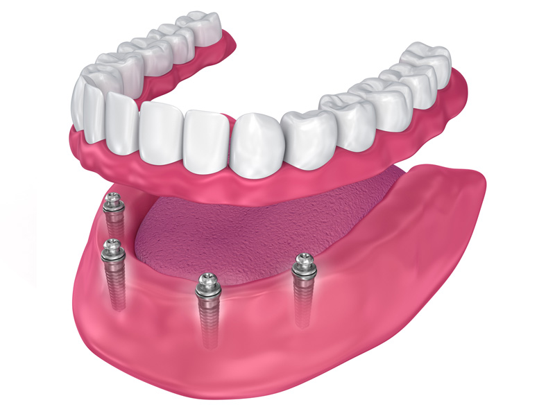 All-On-4 Temecula 3D Dental Implant Rendering