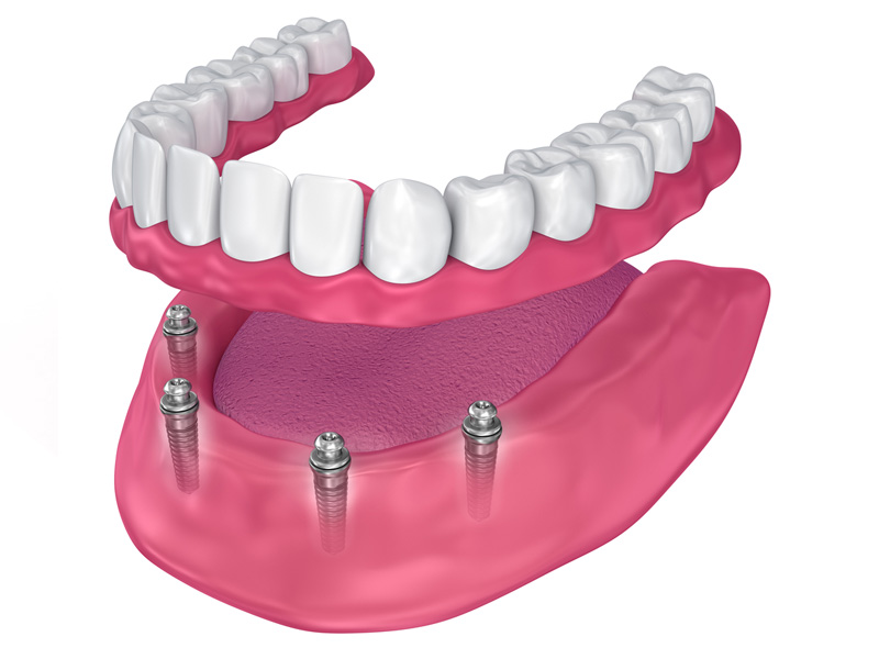 All-On-4_DentalImplants_Temecula All-On-4 Temecula 3D Dental Implant Rendering