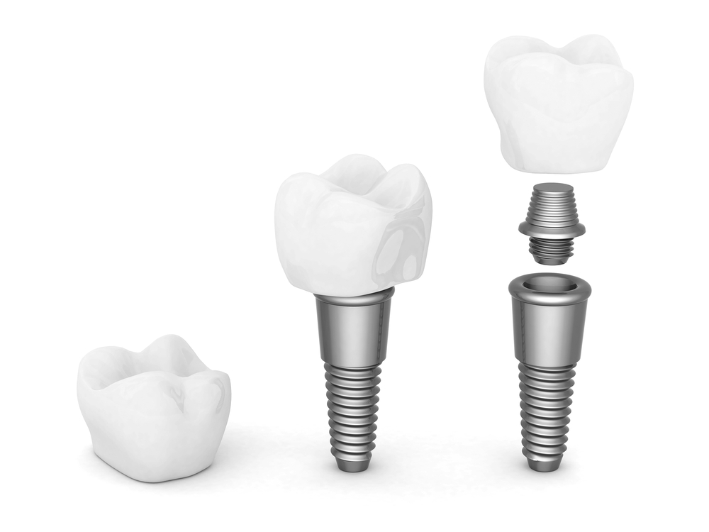 3D Renderings of Teeth for Dental Implants Temecula