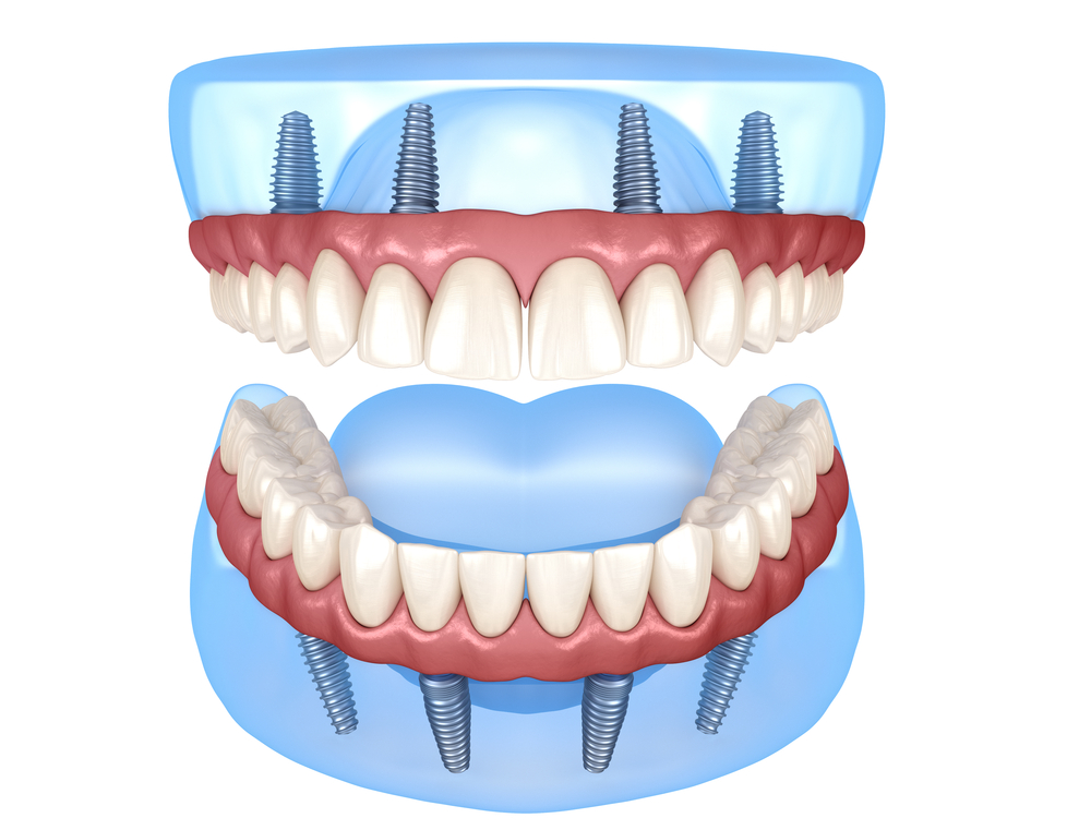 All-On-4 Top and Bottom jaw 3D Dental Implants Rendering