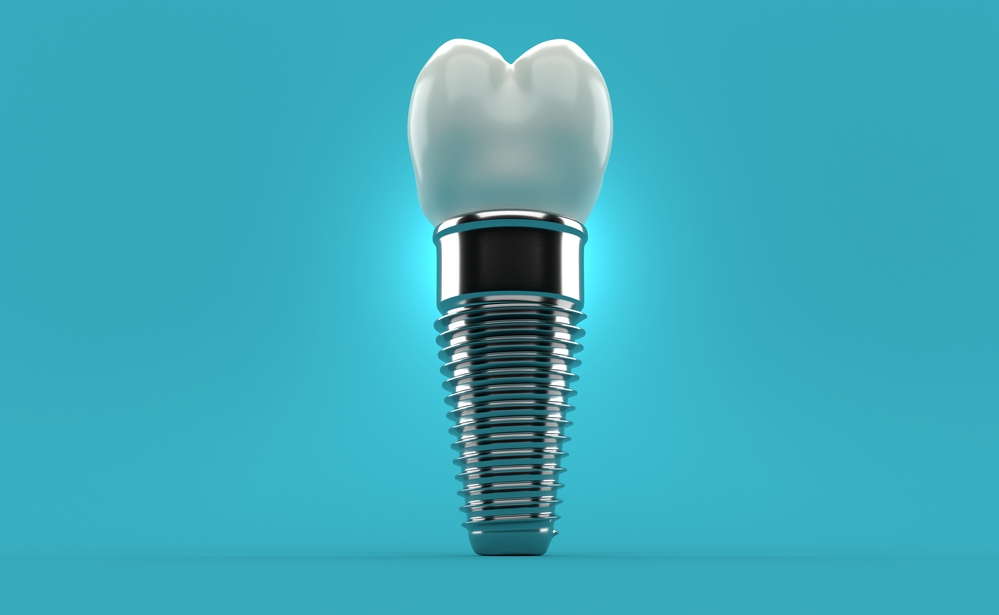 Dental implant Single Tooth Implant Temecula