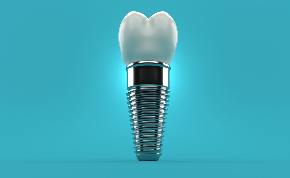 Single Tooth Implant Temecula